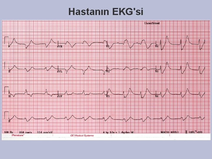 Hastanın EKG'si Hastanın EKG'si