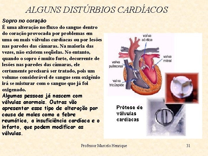 ALGUNS DISTÚRBIOS CARDÍACOS Sopro no coração É uma alteração no fluxo do sangue dentro