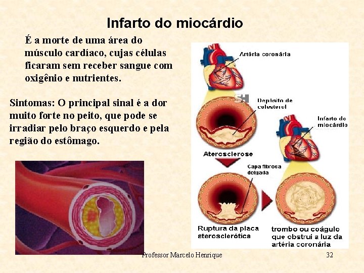 Infarto do miocárdio É a morte de uma área do músculo cardíaco, cujas células