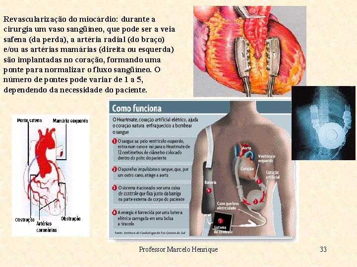 Revascularização do miocárdio: durante a cirurgia um vaso sangüíneo, que pode ser a veia