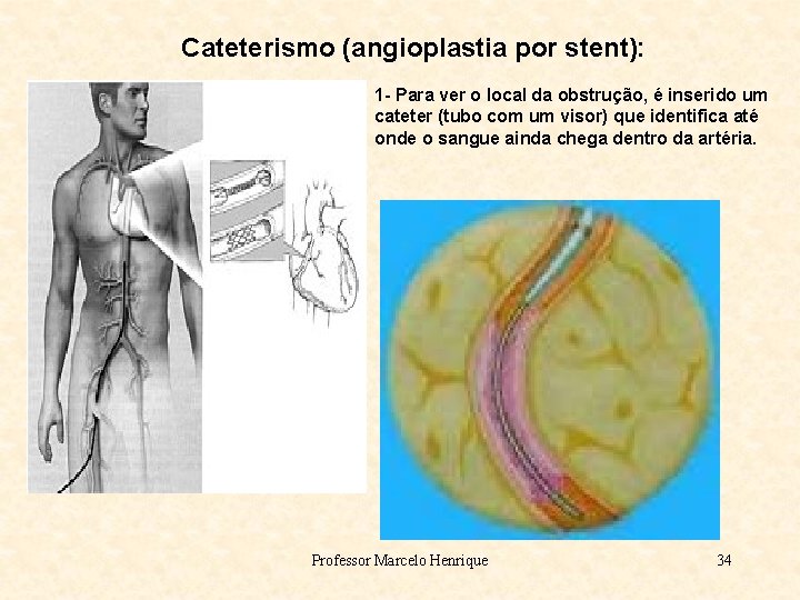 Cateterismo (angioplastia por stent): 1 - Para ver o local da obstrução, é inserido