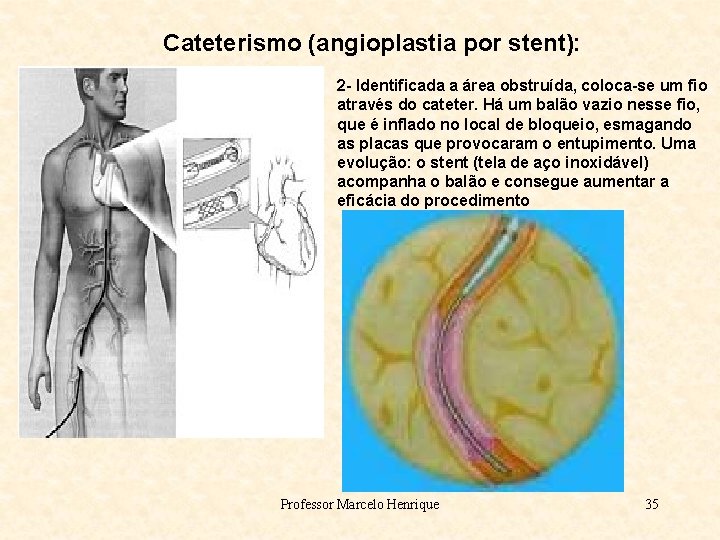 Cateterismo (angioplastia por stent): 2 - Identificada a área obstruída, coloca-se um fio através