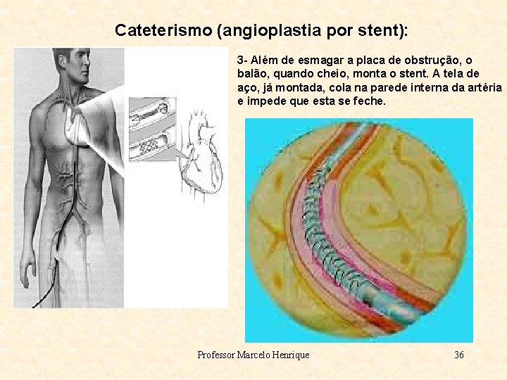 Cateterismo (angioplastia por stent): 3 - Além de esmagar a placa de obstrução, o