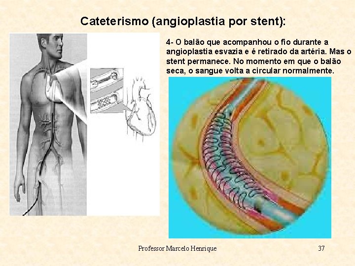 Cateterismo (angioplastia por stent): 4 - O balão que acompanhou o fio durante a