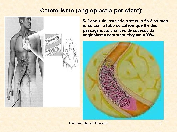 Cateterismo (angioplastia por stent): 5 - Depois de instalado o stent, o fio é