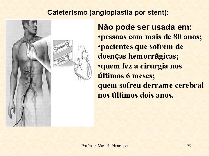 Cateterismo (angioplastia por stent): Não pode ser usada em: • pessoas com mais de