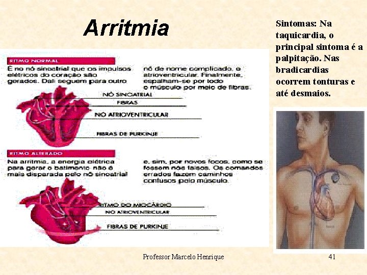 Arritmia Professor Marcelo Henrique Sintomas: Na taquicardia, o principal sintoma é a palpitação. Nas