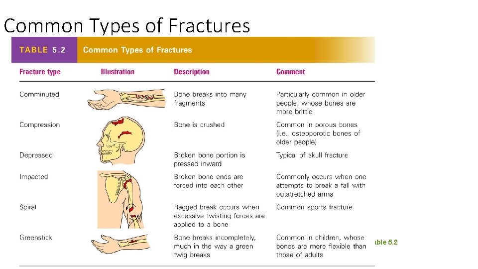 Common Types of Fractures Table 5. 2 Common Types of Fractures Table 5. 2