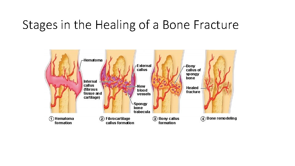 Stages in the Healing of a Bone Fracture Hematoma Internal callus (fibrous tissue and Stages in the Healing of a Bone Fracture Hematoma Internal callus (fibrous tissue and