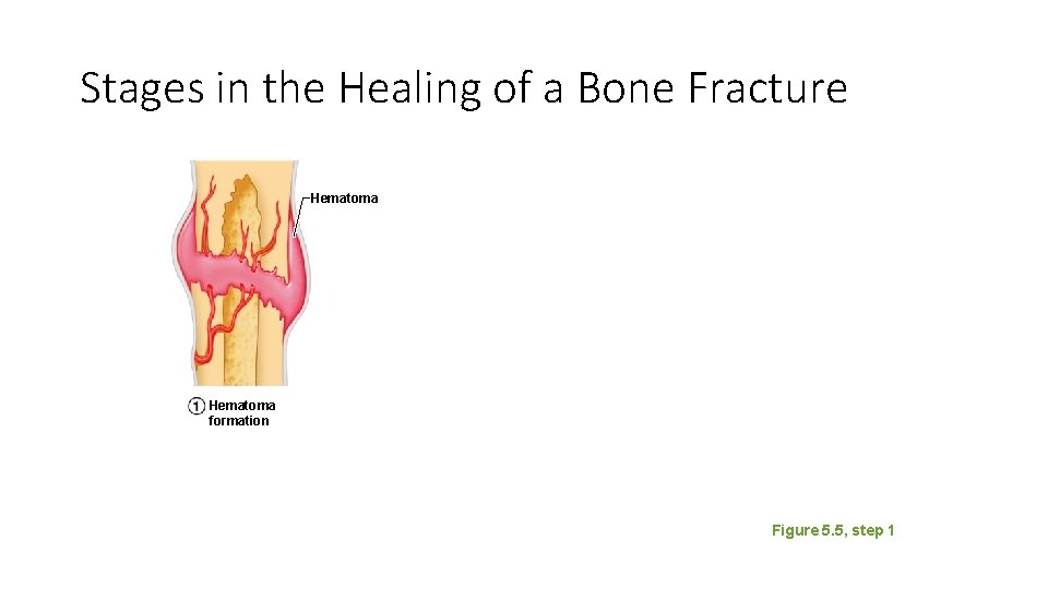 Stages in the Healing of a Bone Fracture Hematoma formation Figure 5. 5, step Stages in the Healing of a Bone Fracture Hematoma formation Figure 5. 5, step