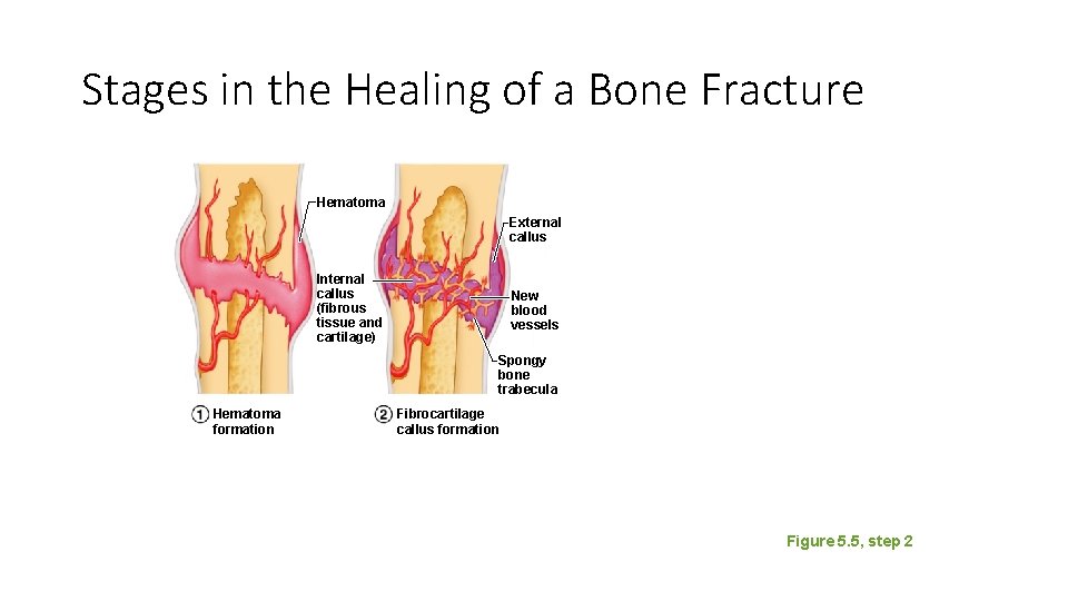 Stages in the Healing of a Bone Fracture Hematoma External callus Internal callus (fibrous Stages in the Healing of a Bone Fracture Hematoma External callus Internal callus (fibrous