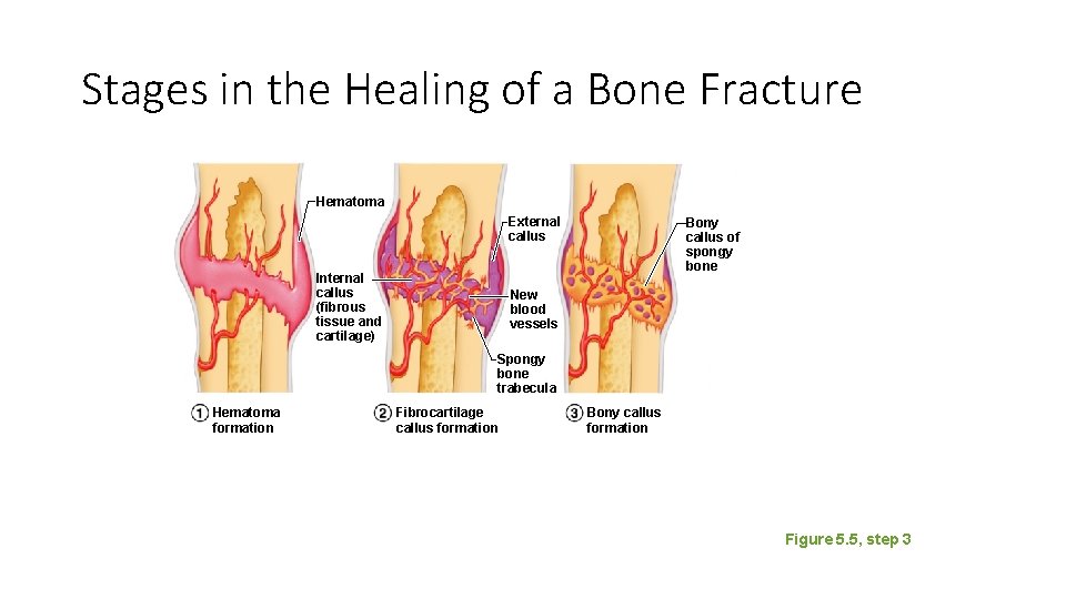 Stages in the Healing of a Bone Fracture Hematoma External callus Internal callus (fibrous Stages in the Healing of a Bone Fracture Hematoma External callus Internal callus (fibrous