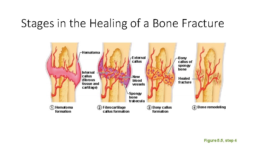 Stages in the Healing of a Bone Fracture Hematoma Internal callus (fibrous tissue and Stages in the Healing of a Bone Fracture Hematoma Internal callus (fibrous tissue and