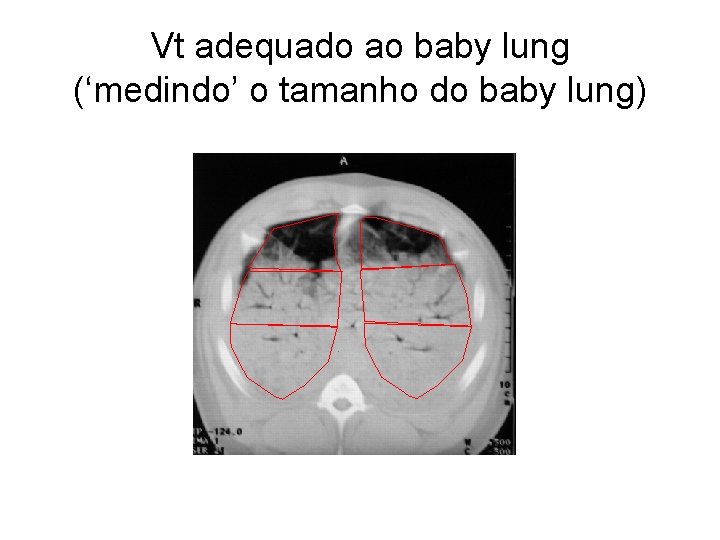 Vt adequado ao baby lung (‘medindo’ o tamanho do baby lung) Vt adequado ao baby lung (‘medindo’ o tamanho do baby lung)