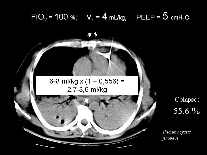 FIO 2 = 100 %; VT = 4 m. L/kg; PEEP = 5 cm. FIO 2 = 100 %; VT = 4 m. L/kg; PEEP = 5 cm.