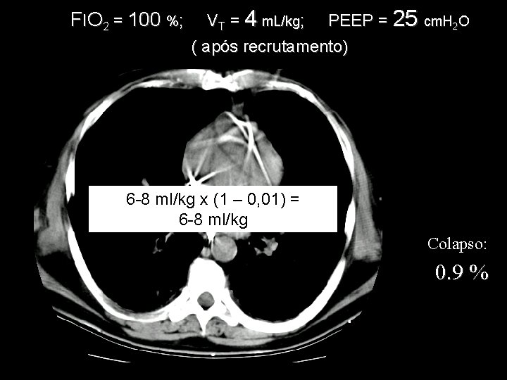 FIO 2 = 100 %; VT = 4 m. L/kg; PEEP = 25 cm. FIO 2 = 100 %; VT = 4 m. L/kg; PEEP = 25 cm.