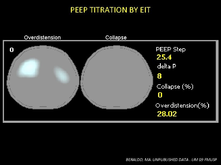 PEEP TITRATION BY EIT Overdistension Collapse BERALDO, MA. UNPUBLISHED DATA. LIM 09 FMUSP PEEP TITRATION BY EIT Overdistension Collapse BERALDO, MA. UNPUBLISHED DATA. LIM 09 FMUSP