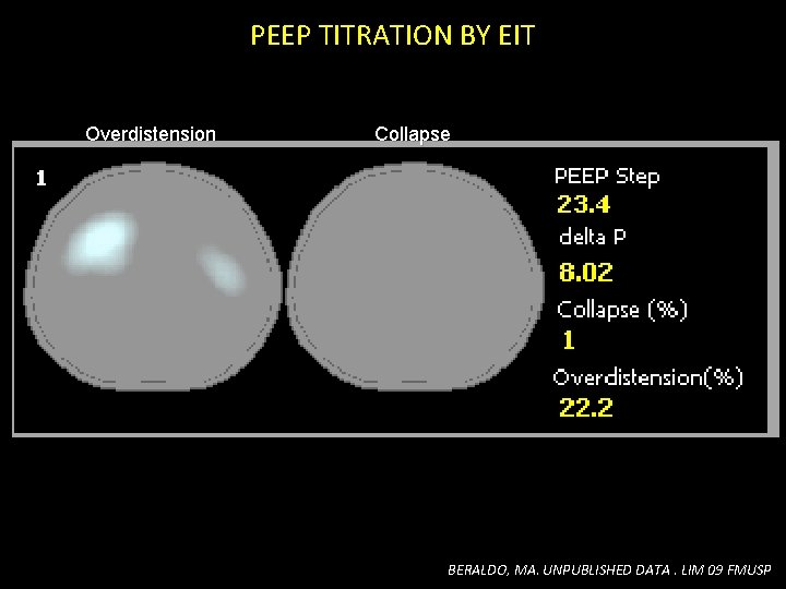 PEEP TITRATION BY EIT Overdistension Collapse BERALDO, MA. UNPUBLISHED DATA. LIM 09 FMUSP PEEP TITRATION BY EIT Overdistension Collapse BERALDO, MA. UNPUBLISHED DATA. LIM 09 FMUSP