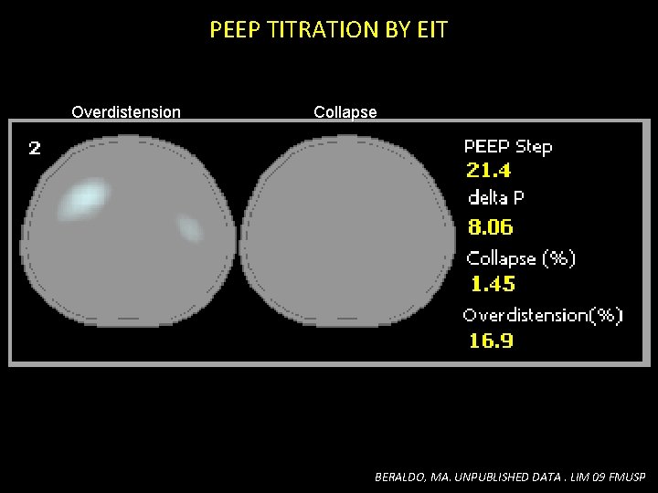 PEEP TITRATION BY EIT Overdistension Collapse BERALDO, MA. UNPUBLISHED DATA. LIM 09 FMUSP PEEP TITRATION BY EIT Overdistension Collapse BERALDO, MA. UNPUBLISHED DATA. LIM 09 FMUSP