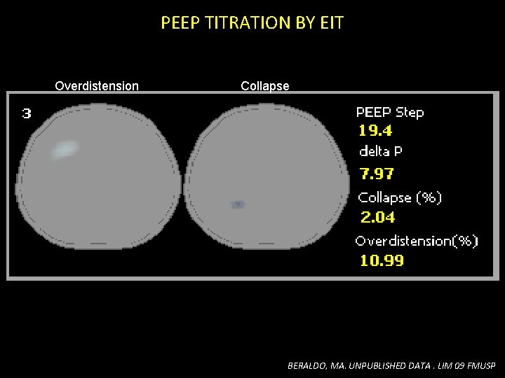 PEEP TITRATION BY EIT Overdistension Collapse BERALDO, MA. UNPUBLISHED DATA. LIM 09 FMUSP PEEP TITRATION BY EIT Overdistension Collapse BERALDO, MA. UNPUBLISHED DATA. LIM 09 FMUSP