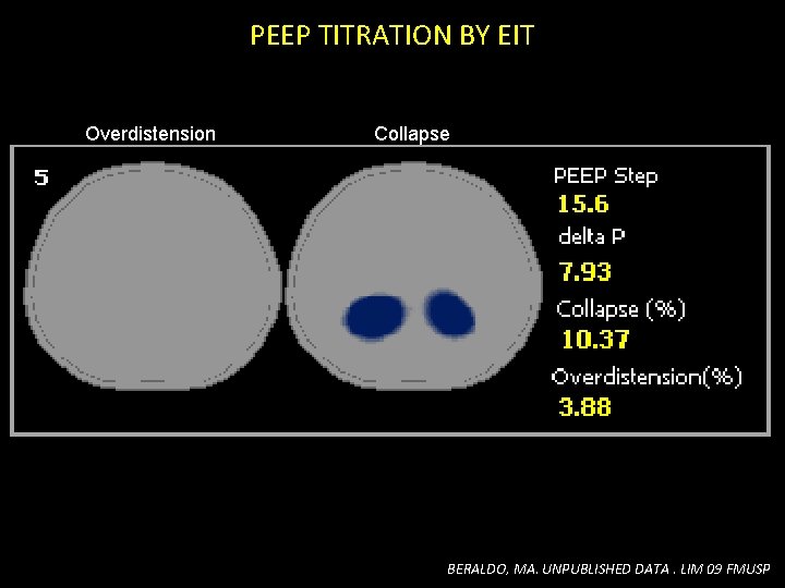 PEEP TITRATION BY EIT Overdistension Collapse BERALDO, MA. UNPUBLISHED DATA. LIM 09 FMUSP PEEP TITRATION BY EIT Overdistension Collapse BERALDO, MA. UNPUBLISHED DATA. LIM 09 FMUSP