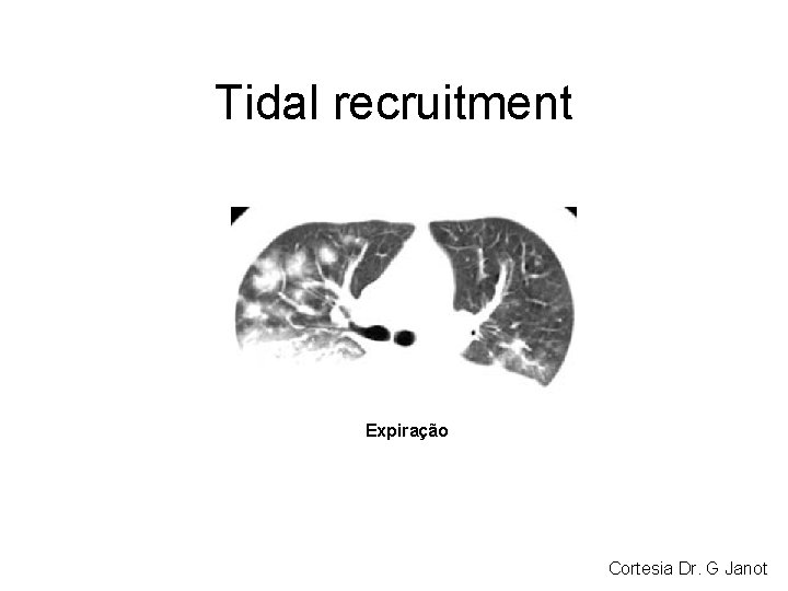 Tidal recruitment Expiração Cortesia Dr. G Janot Tidal recruitment Expiração Cortesia Dr. G Janot