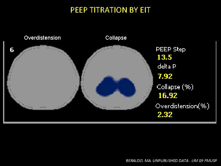 PEEP TITRATION BY EIT Overdistension Collapse BERALDO, MA. UNPUBLISHED DATA. LIM 09 FMUSP PEEP TITRATION BY EIT Overdistension Collapse BERALDO, MA. UNPUBLISHED DATA. LIM 09 FMUSP
