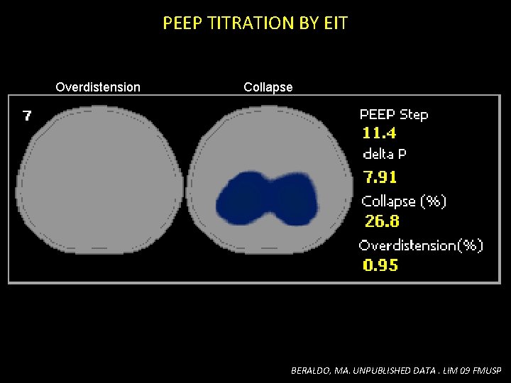 PEEP TITRATION BY EIT Overdistension Collapse BERALDO, MA. UNPUBLISHED DATA. LIM 09 FMUSP PEEP TITRATION BY EIT Overdistension Collapse BERALDO, MA. UNPUBLISHED DATA. LIM 09 FMUSP