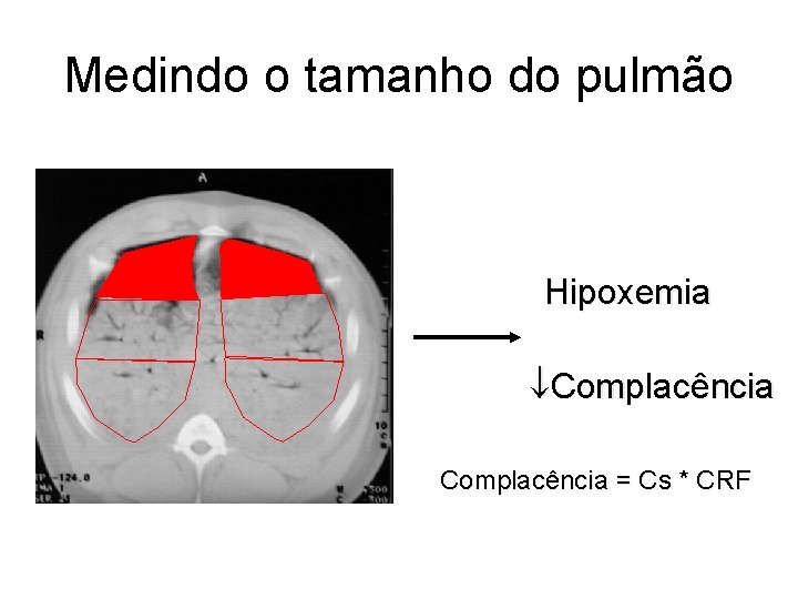 Medindo o tamanho do pulmão Hipoxemia Complacência = Cs * CRF Medindo o tamanho do pulmão Hipoxemia Complacência = Cs * CRF