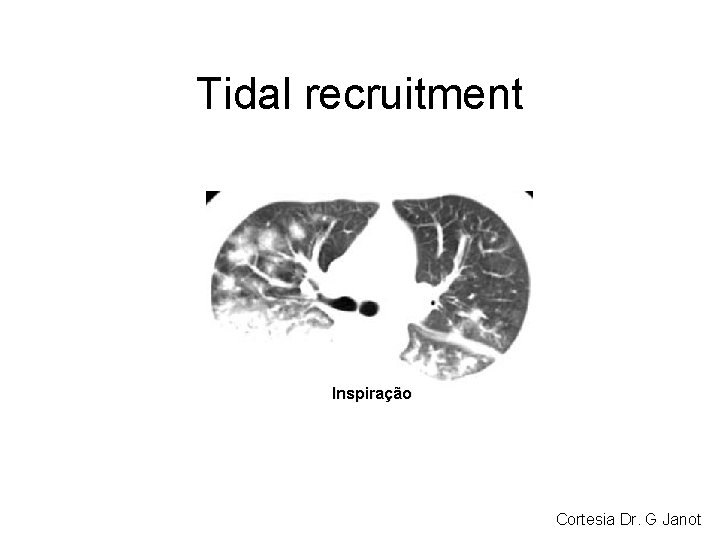 Tidal recruitment Inspiração Cortesia Dr. G Janot Tidal recruitment Inspiração Cortesia Dr. G Janot
