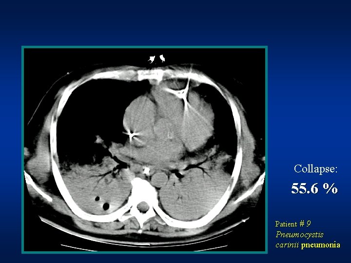 Collapse: 55. 6 % Patient # 9 Pneumocystis carinii pneumonia Collapse: 55. 6 % Patient # 9 Pneumocystis carinii pneumonia