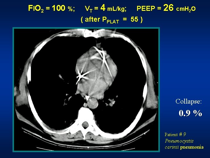 FIO 2 = 100 %; VT = 4 m. L/kg; PEEP = 26 cm. FIO 2 = 100 %; VT = 4 m. L/kg; PEEP = 26 cm.