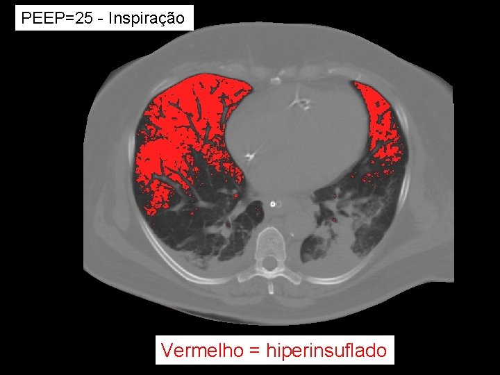 PEEP=25 - Inspiração Vermelho = hiperinsuflado PEEP=25 - Inspiração Vermelho = hiperinsuflado
