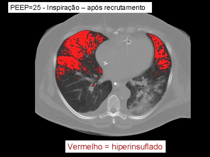 PEEP=25 - Inspiração – após recrutamento Vermelho = hiperinsuflado PEEP=25 - Inspiração – após recrutamento Vermelho = hiperinsuflado