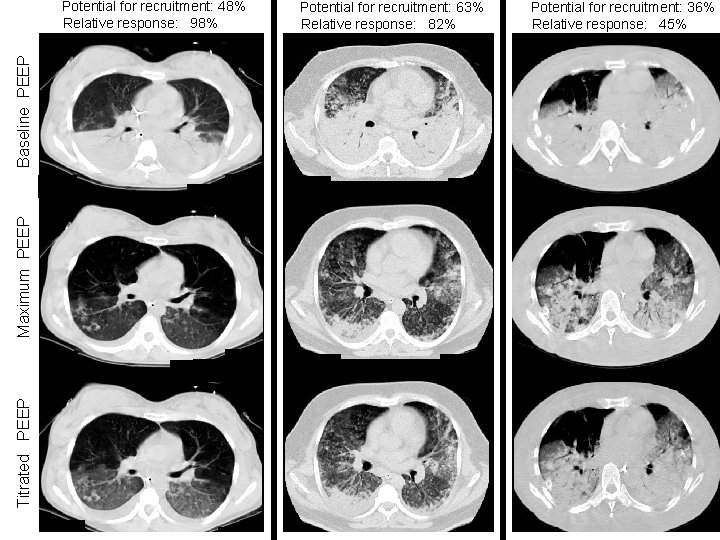 Potential for recruitment: 63% Relative response: 82% Pa. O 2/FIO 2 = 113 Titrated Potential for recruitment: 63% Relative response: 82% Pa. O 2/FIO 2 = 113 Titrated