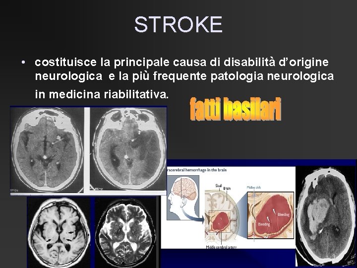 STROKE • costituisce la principale causa di disabilità d’origine neurologica e la più frequente