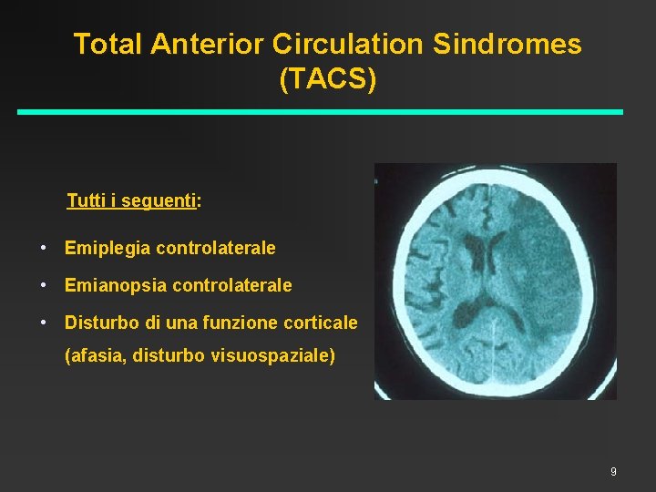 Total Anterior Circulation Sindromes (TACS) Tutti i seguenti: • Emiplegia controlaterale • Emianopsia controlaterale