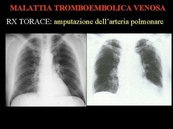 MALATTIA TROMBOEMBOLICA VENOSA RX TORACE: amputazione dell’arteria polmonare 