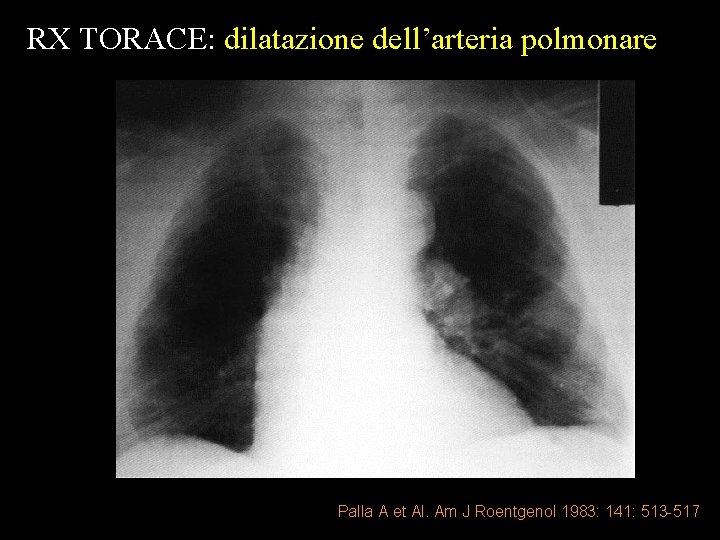 RX TORACE: dilatazione dell’arteria polmonare Palla A et Al. Am J Roentgenol 1983: 141: