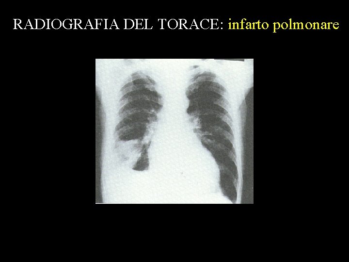 RADIOGRAFIA DEL TORACE: infarto polmonare 