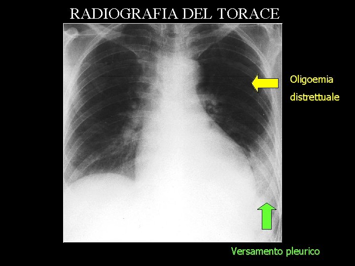 RADIOGRAFIA DEL TORACE Oligoemia distrettuale Versamento pleurico 