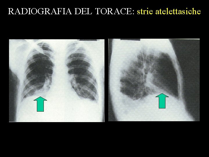 RADIOGRAFIA DEL TORACE: strie atelettasiche 