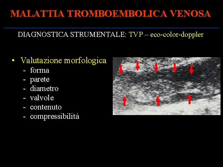 MALATTIA TROMBOEMBOLICA VENOSA DIAGNOSTICA STRUMENTALE: TVP – eco-color-doppler DIAGNOSTICA STRUMENTALE: • Valutazione morfologica -