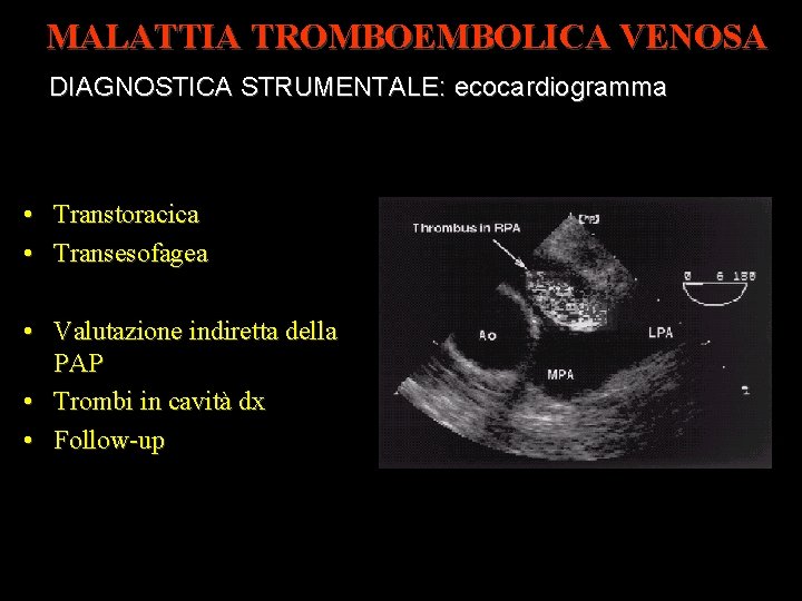 MALATTIA TROMBOEMBOLICA VENOSA DIAGNOSTICA STRUMENTALE: ecocardiogramma • Transtoracica • Transesofagea • Valutazione indiretta della