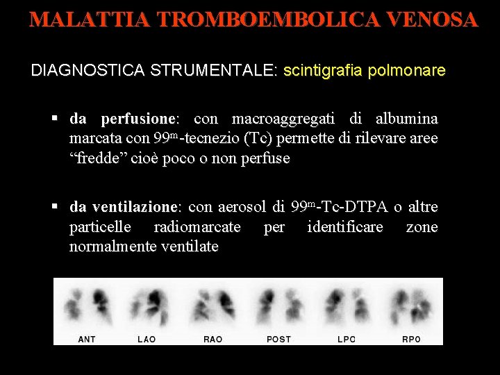 MALATTIA TROMBOEMBOLICA VENOSA DIAGNOSTICA STRUMENTALE: scintigrafia polmonare da perfusione: con macroaggregati di albumina marcata