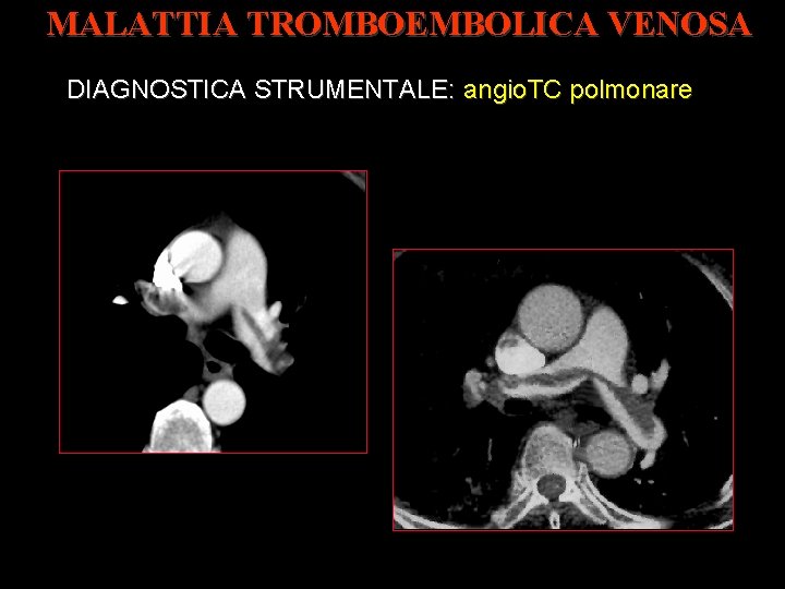 MALATTIA TROMBOEMBOLICA VENOSA DIAGNOSTICA STRUMENTALE: angio. TC polmonare 