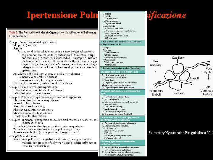 Ipertensione Polmonare: classificazione Pulmonary Hypertension Esc guidelines 2015 