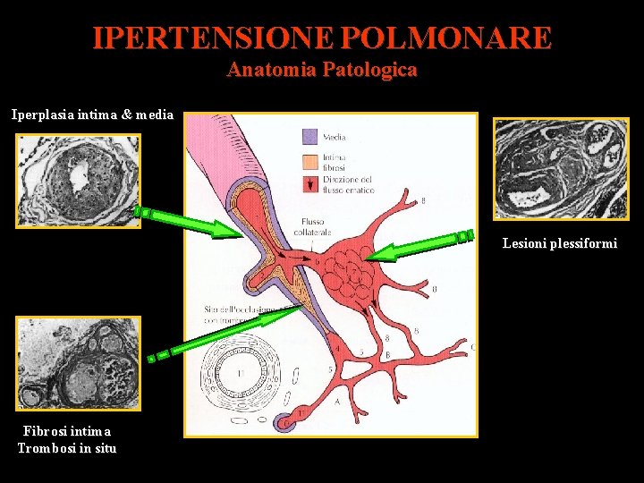 IPERTENSIONE POLMONARE Anatomia Patologica Iperplasia intima & media Lesioni plessiformi Fibrosi intima Trombosi in