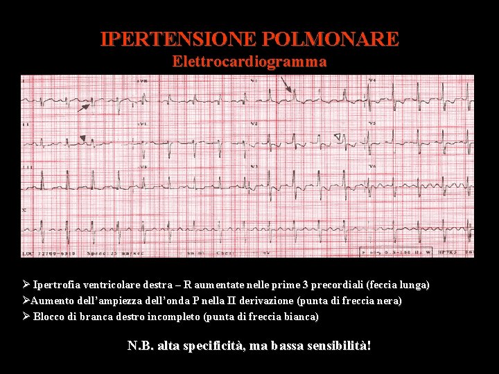 IPERTENSIONE POLMONARE Elettrocardiogramma Ipertrofia ventricolare destra – R aumentate nelle prime 3 precordiali (feccia