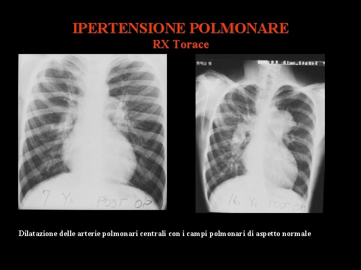 IPERTENSIONE POLMONARE RX Torace Dilatazione delle arterie polmonari centrali con i campi polmonari di